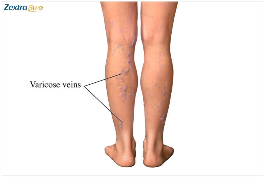 Varicose veins are twisted, bulging veins that cause discomfort